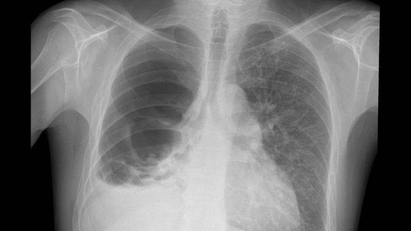 Public and healthcare professionals set to benefit from new joint tuberculosis guideline