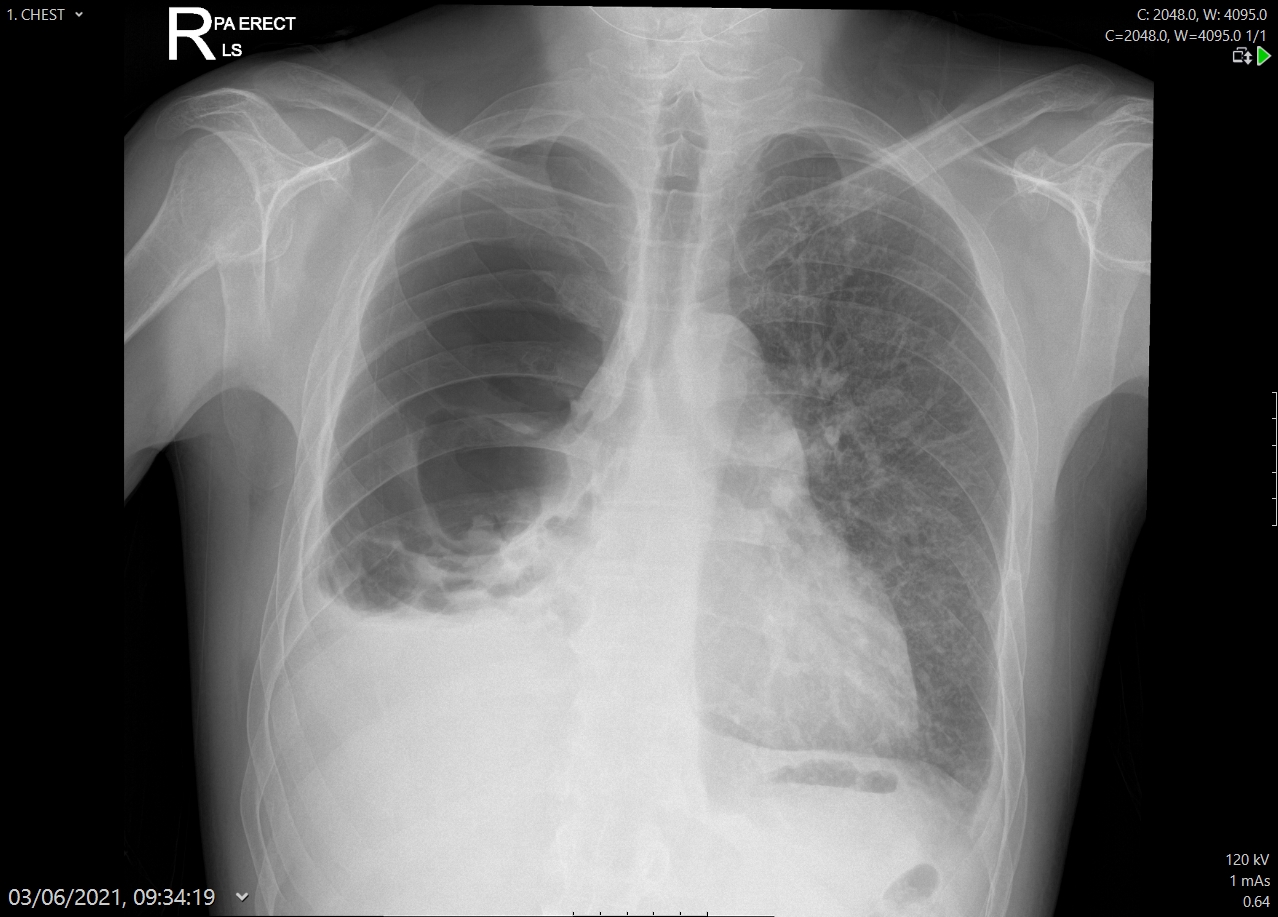 Public and healthcare professionals set to benefit from new joint tuberculosis guideline