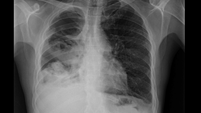 Webinar: fundamentals of TB